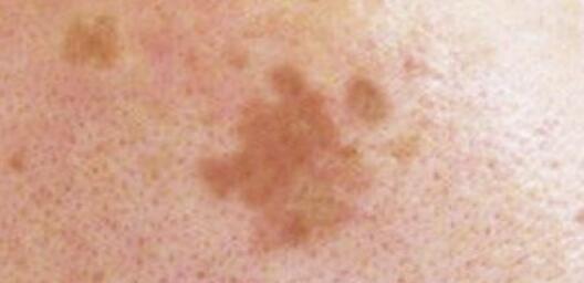 25歲女生長期熬夜長出老年斑